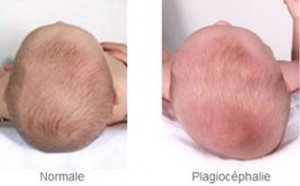 bebe tete plate plagiocephalie