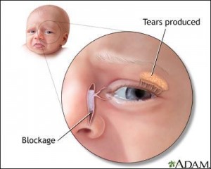 canal lacrymal bouché bébé